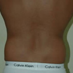 Liposuction - Before