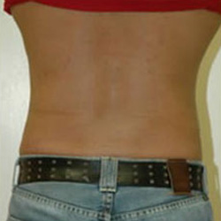 Liposuction - After