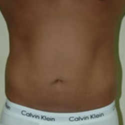 Liposuction - Before