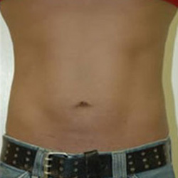 Liposuction - After
