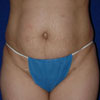 Abdominoplasty