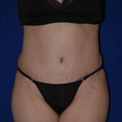 Tummy Tuck - After