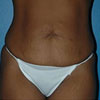 Abdominoplasty