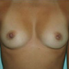 Breast Augmentation
