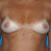 Breast Augmentation