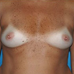 Breast Augmentation - Before