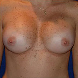 Breast Augmentation - After