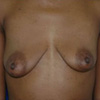 Breast Augmentation