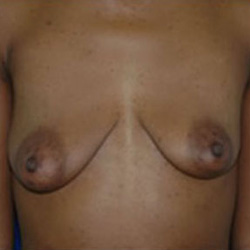 Breast Augmentation - Before