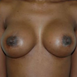 Breast Augmentation - After