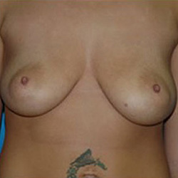 Breast Augmentation - Before