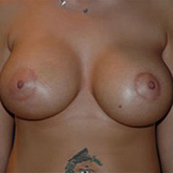 Breast Augmentation - After