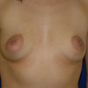 Breast Lift & Augmentation
