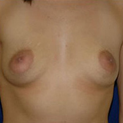Breast Augmentation - Before