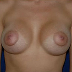 Breast Augmentation - After
