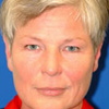 Blepharoplasty (Brow Lift)
