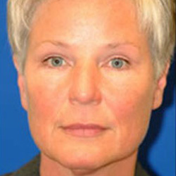 Endoscopic Brow Lift - After