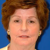 Brow & Face Lift
