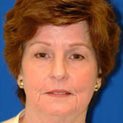 Brow Lift