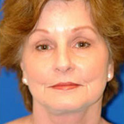 Brow Lift
