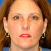 Brow & Face Lift