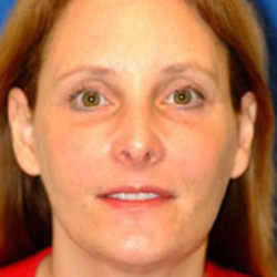 Brow & Facelift - After