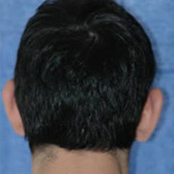 Otoplasty (Ears)