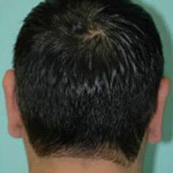 Otoplasty (Ears) - After