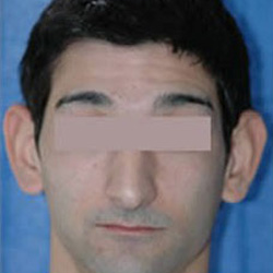 Otoplasty (Ears) - Before
