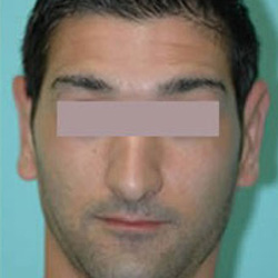 Otoplasty (Ears) - After