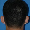 Otoplasty (Ears)