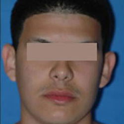 Otoplasty (Ears) - Before