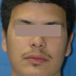 Otoplasty (Ears) - After