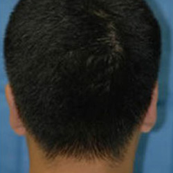Otoplasty (Ears) - After