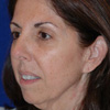 Facelift