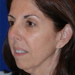 Facelift - Before