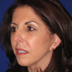 Facelift - After