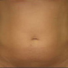 Liposuction