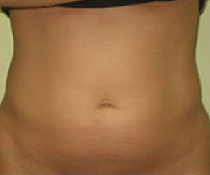 Liposuction - Before