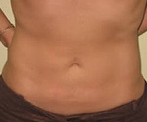 Liposuction - After