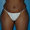 Liposuction