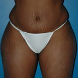 Liposuction - Before