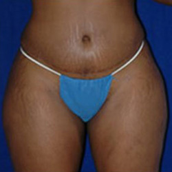 Liposuction - After