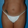 Liposuction