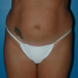 Liposuction - Before