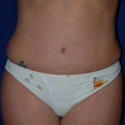 Liposuction - After