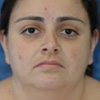 Facial Liposuction