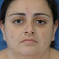 Facial Liposuction - Before