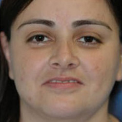 Facial Liposuction - After