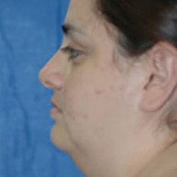 Facial Liposuction - Before